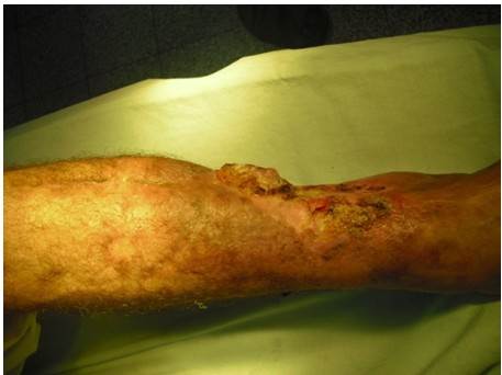 Vista lateral que muestra la &uacute;lcera sobre la cicatriz vegetante y de r&aacute;pido crecimiento.