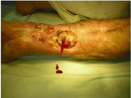 Vista frontal que muestra la friabilidad de la &uacute;lcera as&iacute; como el sangrado f&aacute;cil.