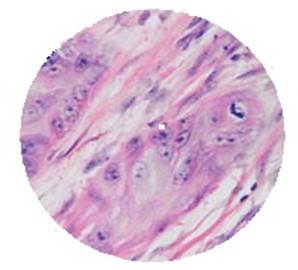 Se destacan las atipias celulares con citoplasma amplio, inmersas en estroma fibroso. Tinci&oacute;n HE x 30.