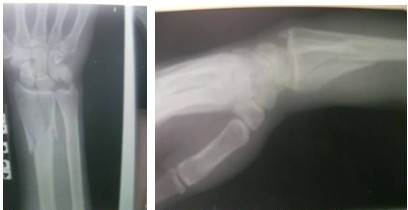 Im&aacute;genes radiol&oacute;gicas anteroposterior y lateral de mu&ntilde;eca donde se observa la fractura cominuta, articular del extremo distal del radio.