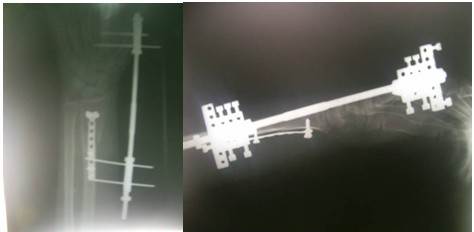 Im&aacute;genes radiogr&aacute;ficas posoperatorias anteroposterior y lateral que muestran la reducci&oacute;n anat&oacute;mica de la fractura y la combinaci&oacute;n de placa de microtornillos, colocadas volarmente, y el minifijador RALCA.