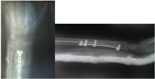 Radiograf&iacute;as anteroposterior y lateral a las cuatro semanas de operada que muestran la f&eacute;rula ante braquial.