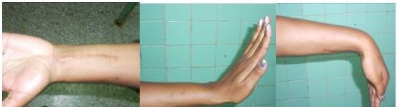 Im&aacute;genes donde se pueden observar la cicatriz de la operaci&oacute;n y los puntos donde estuvo el minifijador, adem&aacute;s de la funci&oacute;n de flexi&oacute;n dorsal y palmar de la mano, a las diez semanas de operada.