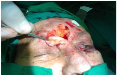 Imagen que muestra la ex&eacute;resis del tumor en el p&aacute;rpado superior derecho.