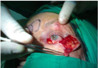 Imagen que muestra la ex&eacute;resis del tumor en el p&aacute;rpado inferior izquierdo.