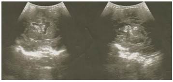 Im&aacute;genes ultrasonogr&aacute;ficas que muestran corte coronal y sagital utilizando como ventana ac&uacute;stica la fontanela anterior. Se observa imagen ecog&eacute;nica irregular localizada en la regi&oacute;n subenpendimaria derecha.