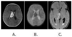 Resonancia magn&eacute;tica con secuencias en T1(A) T2(B) y FLAIR(C) con im&aacute;genes de intensidades heterog&eacute;neas en espacio subependimario que se abre a ventr&iacute;culos laterales en relaci&oacute;n con hemorragia subependimaria e intraventricular.