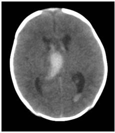 Tomograf&iacute;a axial computarizada simple de cr&aacute;neo, con corte a 3 mm. que muestra la presencia de sangre en matriz germinal y ventr&iacute;culos laterales, confirmando el diagn&oacute;stico de hemorragia de la matriz germinal.