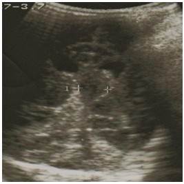 Corte coronal de ultrasonograf&iacute;a de control a los 5 d&iacute;as que revela mejor&iacute;a imagenol&oacute;gica con reducci&oacute;n del tama&ntilde;o de la lesi&oacute;n. El reci&eacute;n nacido mostraba evoluci&oacute;n cl&iacute;nica favorable.