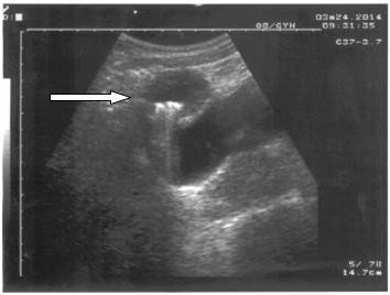 Imagen redondeada, hipoecogénica, con calcificaciones de 38 x 42 mm. en su interior