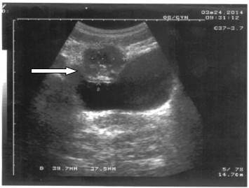 Imagen anterior donde se observa desplazamiento de la vejiga hacia abajo.