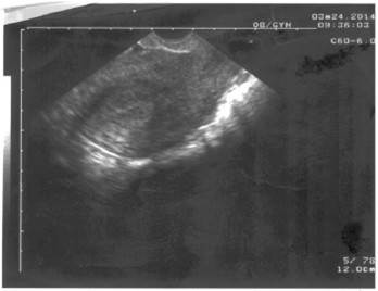 Útero de tamaño normal sin dispositivo intrauterino.