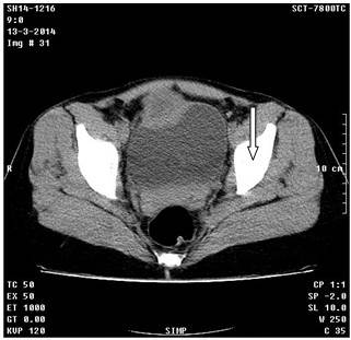 Imagen hipodensa de 38 x 41 mm., con una pared gruesa de 12 mm., con elemento metálico en su interior.