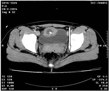 Imagen hipodensa de 38 x 41 mm., con una pared gruesa de 12 mm que aumentó su densidad con la administración de contraste, y con elemento metálico en su interior.