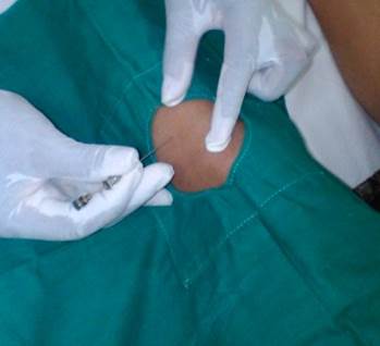 Implantación de catgut en estómago 36