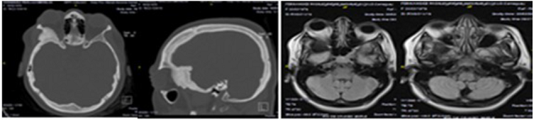 Lesi&oacute;n predominantemente &oacute;sea que ocupa la pared lateral de la &oacute;rbita derecha con crecimiento extra e intraorbitario. A la izquierda una vista sagital en ventana &oacute;sea y una vista axial en ventana &oacute;sea obtenida por tomograf&iacute;a axial computarizada. A la derecha la resonancia magn&eacute;tica de cr&aacute;neo evidencia una lesi&oacute;n extra axial hipointensa, a nivel de la pared lateral de la &oacute;rbita con extensi&oacute;n extra e intraorbitaria con comportamiento similar a la tomograf&iacute;a axial computarizada.