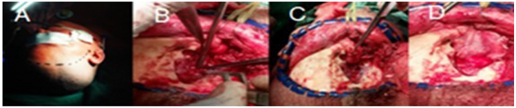 Im&aacute;genes del proceder quir&uacute;rgico. A: incisi&oacute;n arciforme en regi&oacute;n frontolateral derecha. B: resecci&oacute;n de la pared lateral de la &oacute;rbita con exposici&oacute;n de la lesi&oacute;n. C: exc&eacute;resis de la lesi&oacute;n. D: zona de defecto &oacute;seo y reconstrucci&oacute;n con tejido epicraneal. 