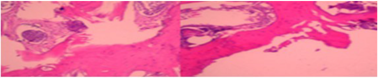 En la histolog&iacute;a se observ&oacute; tejido &oacute;seo cortical y esponjoso con ampliaci&oacute;n irregular de los canales y espacios intertrabeculares, ocupados por un tejido fibroso muy vascularizado en cuyo seno se observa proliferaci&oacute;n celular que constitu&iacute;a nidos bien delimitados con un patr&oacute;n arremolinado. Las c&eacute;lulas uniformes en cuanto a tama&ntilde;o y morfolog&iacute;a, muestran citoplasmas mal definidos y n&uacute;cleos redondeados u ovoideos con un peque&ntilde;o y &uacute;nico nucl&eacute;olo, con ocasionales pseudoinclusiones, sin atipia y sin mitosis. 