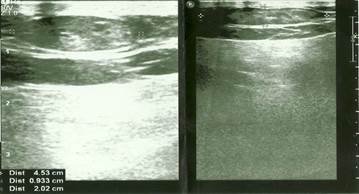 Ultrasonografía de partes blandas. Imagen hipoecóica, ovalada de contornos regulares y bordes bien definidos.