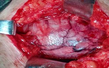 Cirugía. A: abordaje transglúteo.