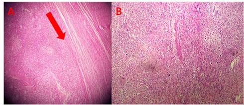 Histología. A: demarcación de la zona normal y la zona tumoral (flecha roja). B: abundante zona de mitosis.