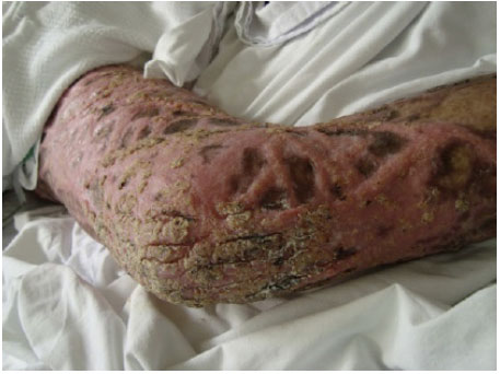Cromoblastomicosis.
