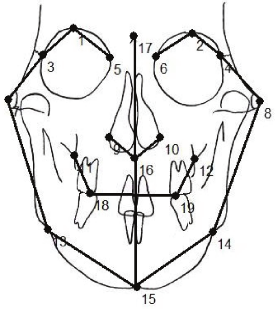 Figure 2. Cephalometric landmarks for thin-plate spline
analysis (the lines are merely illustrative and were not used for evaluation purposes).