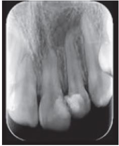 Radiografía periapical. Diente 2.2 inicial.
