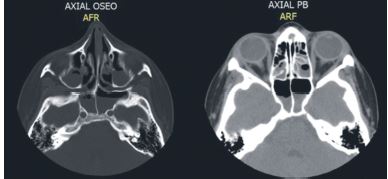 Tomografía Axial Computarizada. Corte axial óseo (izquierda) y corte axial de tejidos blandos (derecha).