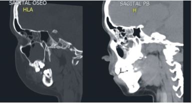 Tomografía Axial Computarizada. Corte sagital óseo (izquierda) y corte sagital de tejidos blandos (derecha).