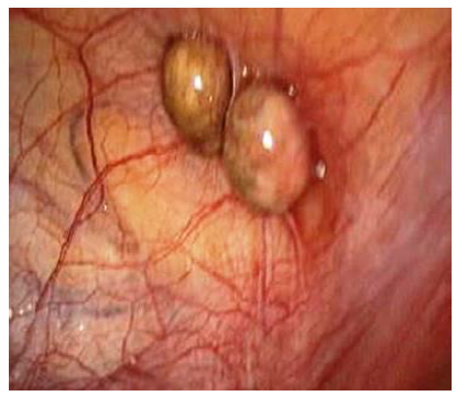 Ap&eacute;ndice epiploica en cara anterior del ciego.