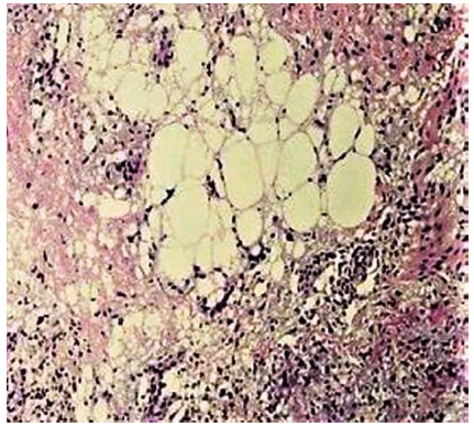 Tejido adiposo
con necrosis extensa dentro del ap&eacute;ndice epiploica
infartada. Ciego.