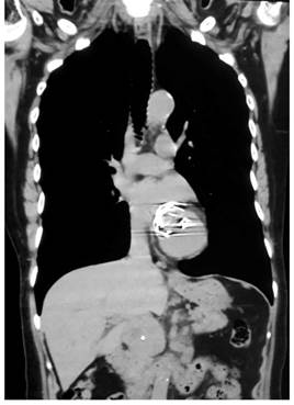 TAC de la masa o adenomegalia retroperitoneal detr&aacute;s de la cabeza de p&aacute;ncreas