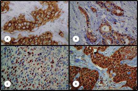 Expresi&oacute;n de prote&iacute;nas estudiadas por inmunohistoqu&iacute;mica en matrices de tejidos. (A) receptor del factor de crecimiento epid&eacute;rmico 1 (egfr). (B) C-kit. (C) p63. (D) survivina. Aumento original de 200x.