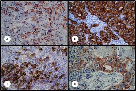 Expresi&oacute;n de prote&iacute;nas estudiadas por inmunohistoqu&iacute;mica en matrices de tejidos. (A) CK5/6. (B) CK8/18. (C) CK14. (D) CK17. Aumento original de 200x.