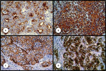 Expresi&oacute;n de prote&iacute;nas estudiadas por inmunohistoqu&iacute;mica en matrices de tejidos. (A) CK APM. (B) Vimentina. (C) Cadherina E. (D) Cadherina P. Aumento original de 200x.