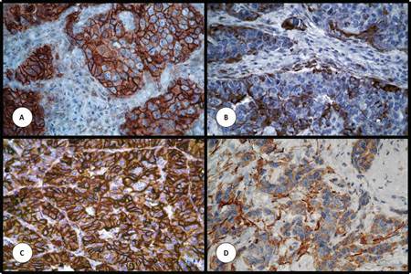 Expresi&oacute;n de prote&iacute;nas estudiadas por inmunohistoqu&iacute;mica en matrices de tejidos. (A) p120. (B) Actina de m&uacute;sculo liso. (C) Alfa actina. (D) Calponina. Aumento original de 200x.