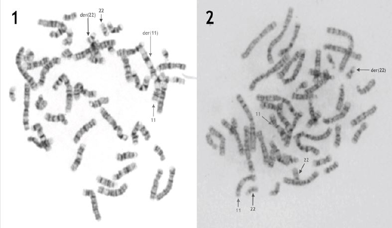 1- The mother’s karyotype shows a balanced non-Robertsonian translocation between chromosome 11 and chromosome 22. 2- The patient’s karyotype shows a supernumerary derivative 22 chromosome.
