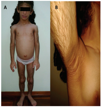 Preescolar femenino de 4 a&ntilde;os de edad, con diagn&oacute;stico de Lipodistrofia cong&eacute;nita generalizada tipo 2 (mutaci&oacute;n del gen BSCL2). A: Se evidencia la ausencia generalizada de tejido adiposo, facies triangular, musculatura bien definida, hipertricosis, acantosis nigricans y abdomen distendido en relaci&oacute;n con hepatomegalia. B: Se observa hipertricosis y acantosis nigricans en cuello y axilas producto de la hiperinsulinemia severa de la paciente.