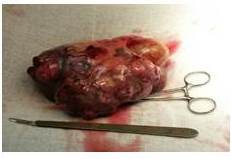 Espécimen quirúrgico de anexo izquierdo que involucra que
involucra lesión.