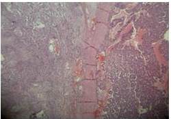 Aspecto Histológico. H-E 40X. Componente mixto: carcinoembrionario
y tumor de seno endodérmico, dado por la presencia de cuerpos de Schiller
Duval.