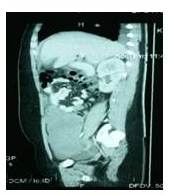 Tomografía abdominopélvica