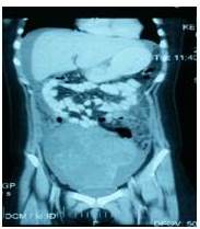 Tomografía abdominopélvica observando lesión
heterogénea, se extiende hacia excavación pélvica, ejerciendo efecto de masa
hacia la vejiga.