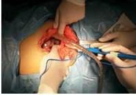 Abordaje de cavidad, toma de muestra y
aspiración de líquido ascítico.