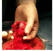 Epiplón acartonado con lesión tumoral de 4 cm
de diámetro, sólida, vascularizada con áreas de necrosis.