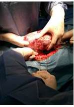 Tumor de ovario
izquierdo