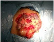 Tumor de ovario
izquierdo