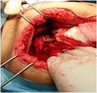 Ovario derecho sin lesiones macroscópicas.
