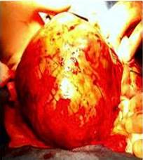 Schwannoma pélvico retroperitoneal benigno durante la
cirugía.