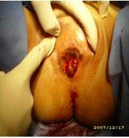 Lesi&oacute;n que compromete hasta 1/3 inferior de vagina  que protruye por introito vaginal y parece evidenciarse satelitosis en vulva